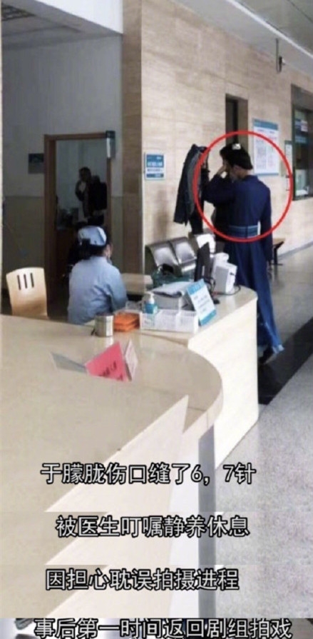 于朦胧左眼收伤吓坏粉丝 原因为被道具戳伤